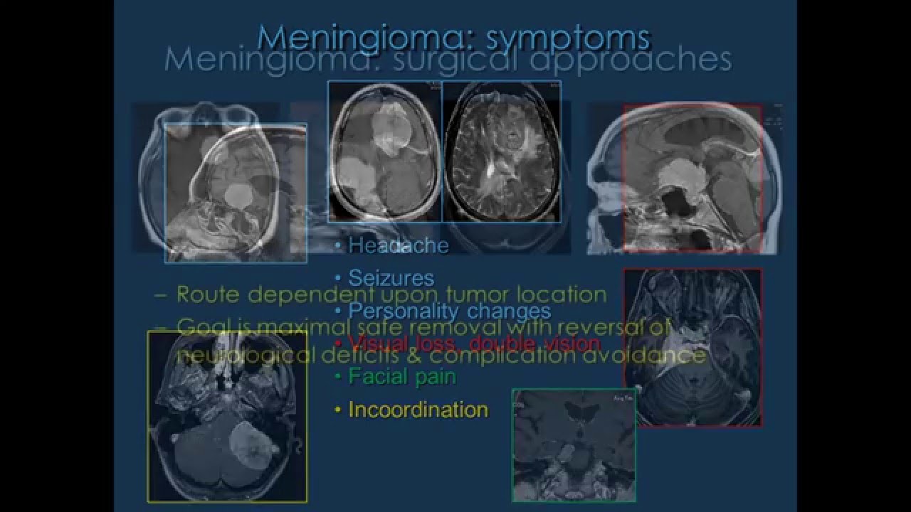 meningioma minimally invasive keyhole endoscopic surgery youtube