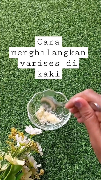 Cara alami menghilangkan varises di kaki #tipsalami #caraalami #obatalami #varises