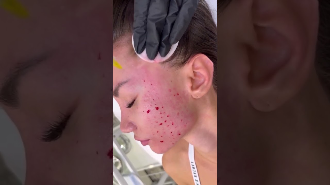 #биоревитализация