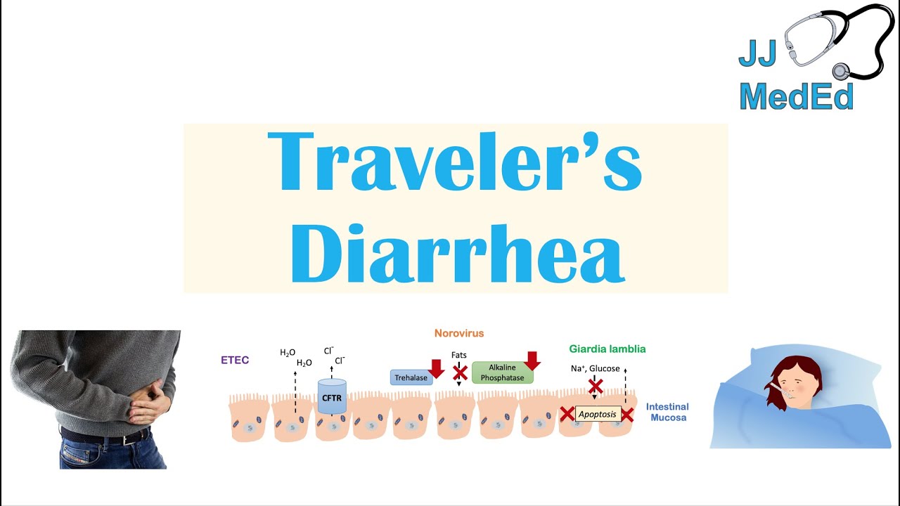 can travelling cause diarrhea