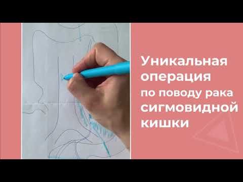 Как сохранить кишечник при раке сигмовидной кишки
