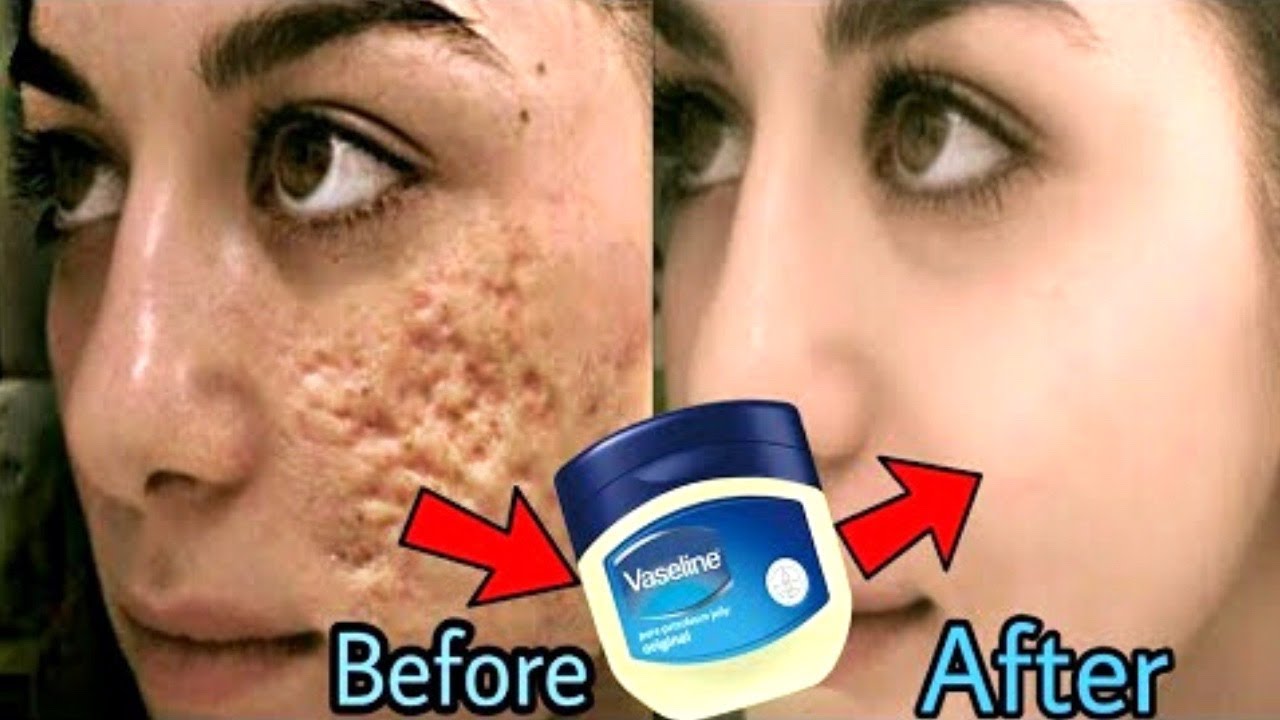 melodisk rester Anstændig Remove DARK SPOTS, ACNE SCARS & PIGMENTATION using Vaseline | Vaseline  Hacks For Fair & Clear Skin - YouTube