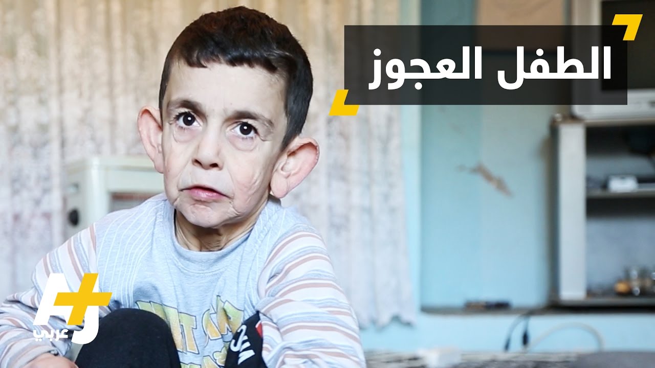 الشيخوخة المبكرة لدى الأطفال