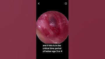 Ear Tube Surgery: Real Surgery Explanation