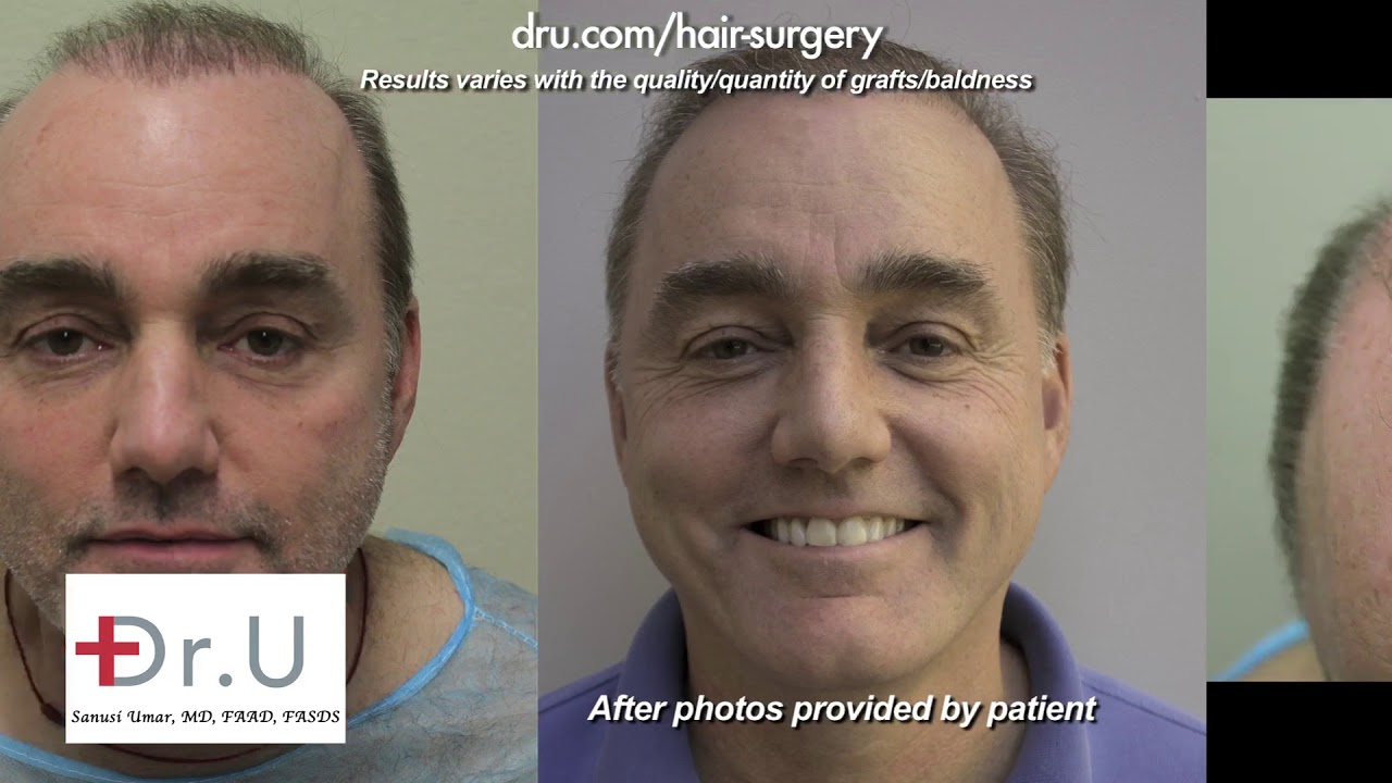 Patient Finally Fixes His Bad 80’s Hair Transplant Mistakes, Thanks to Dr.U