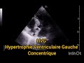 Hvg hypertrophie ventriculaire gauche concentrique chographie