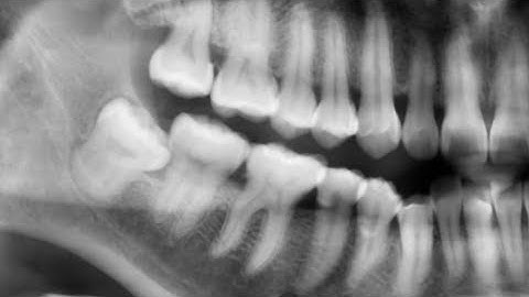 Nhổ răng khôn 48 Bn 1989 - Wisdom Tooth Extraction _ Step By Step #wisdomtooth #extraction