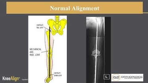 KneeAlign Custom Knee Replacement
