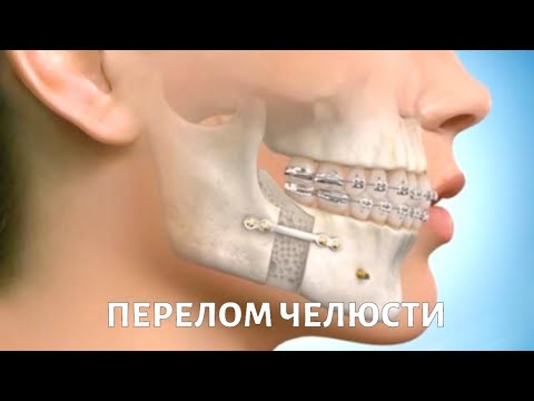 Травмы ЗУБОВ и челюсти: симптомы, первая помощь, лечение