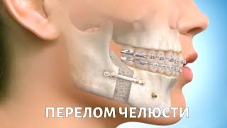 Травмы ЗУБОВ и челюсти: симптомы, первая помощь, лечение