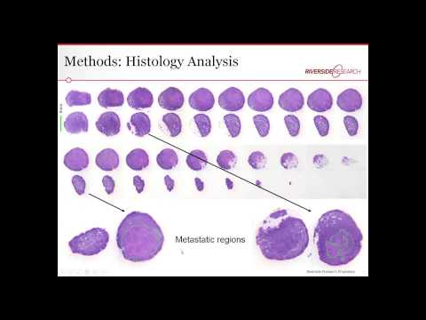 Detecting Cancer in Lymph Nodes Using Quantitative Ultrasound - YouTube