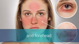 Rosacea And Candida