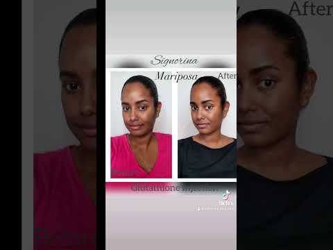 كورس حقن الجلوتاثيون من سنيورينا بالتعاون مع ماري بوسا ب ٣٠٠٠ جنيه لفترة محدودة 