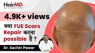 क्या FUE Scars Repair हो सकते है? | Are FUE Scars Repairable? | HairMD, Pune