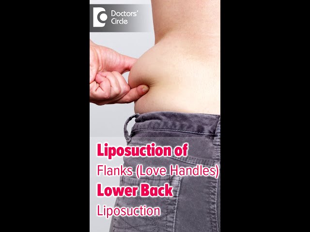 Liposuction of the 'love handles' or flanks