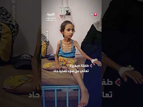 طفلة من غزة تعاني سوء التغذية بسبب نقص الإمدادات