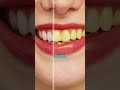 Cómo aclarar tus dientes sin tratamientos costosos