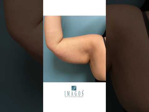 Vaser Assisted Arm