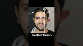 Otoplasty Surgery 