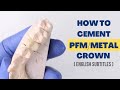 How to cement a pfmmetal crown