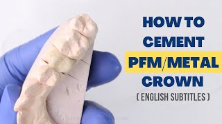 How to Cement a PFM/Metal Crown
