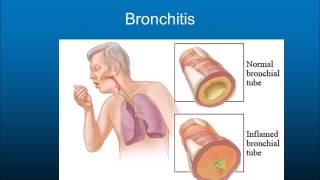 Lung diseases movie