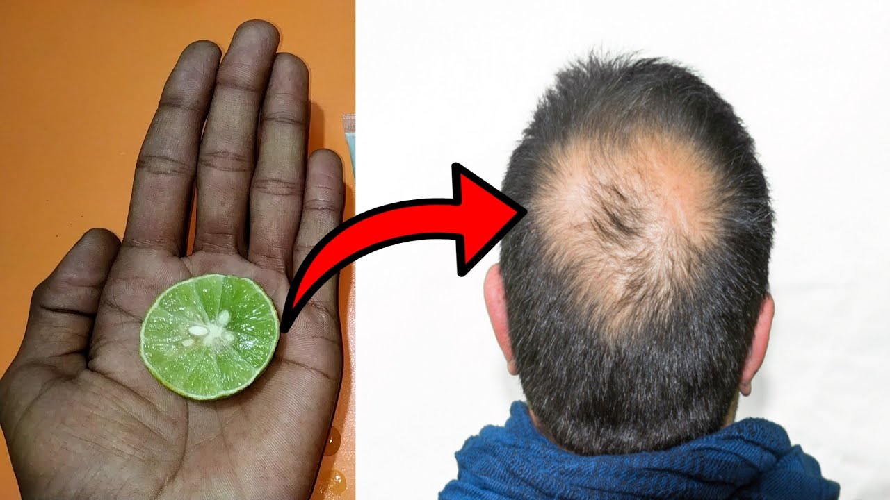 नीबू की रस में मिलादो यह चीज । रात को लगाया सुबह तक सर पर बाल आ जाएंगे । Hair Regrowth Home Remedies - YouTube