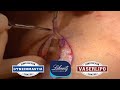 NIPPLE/AEROLA LIFT SURGERY on 51 Year Old NEW JERSEY Male BY Dr. Lebowitz