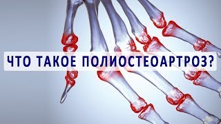 Что такое полиостеоартроз и как его лечат?