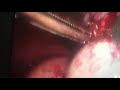 Ablation dun kyste dermoide par coeliochirurgie