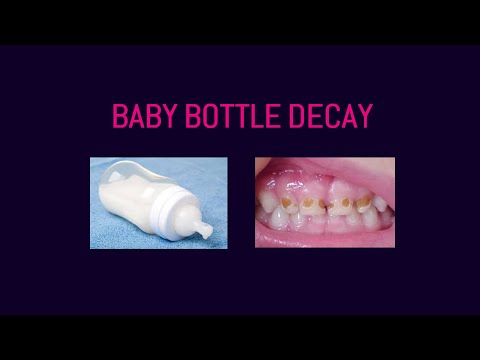 Video: Why Does A Little Child's Teeth Deteriorate?