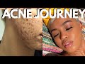 How To Treat Acne Hormonal + Cystic | Hyperpigmentation + Acne On Black Skin