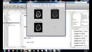 Denoising MRI images for removing rician, gaussian and impulsive noise