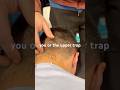 Suboccipital Headache Pain? DESTROY it with Dry Needling