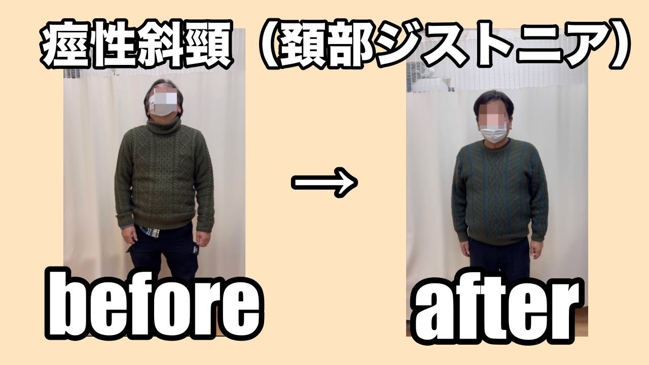 痙性斜頸（頚部ジストニア）　勝手に上を向く症状、ビフォーアフター動画