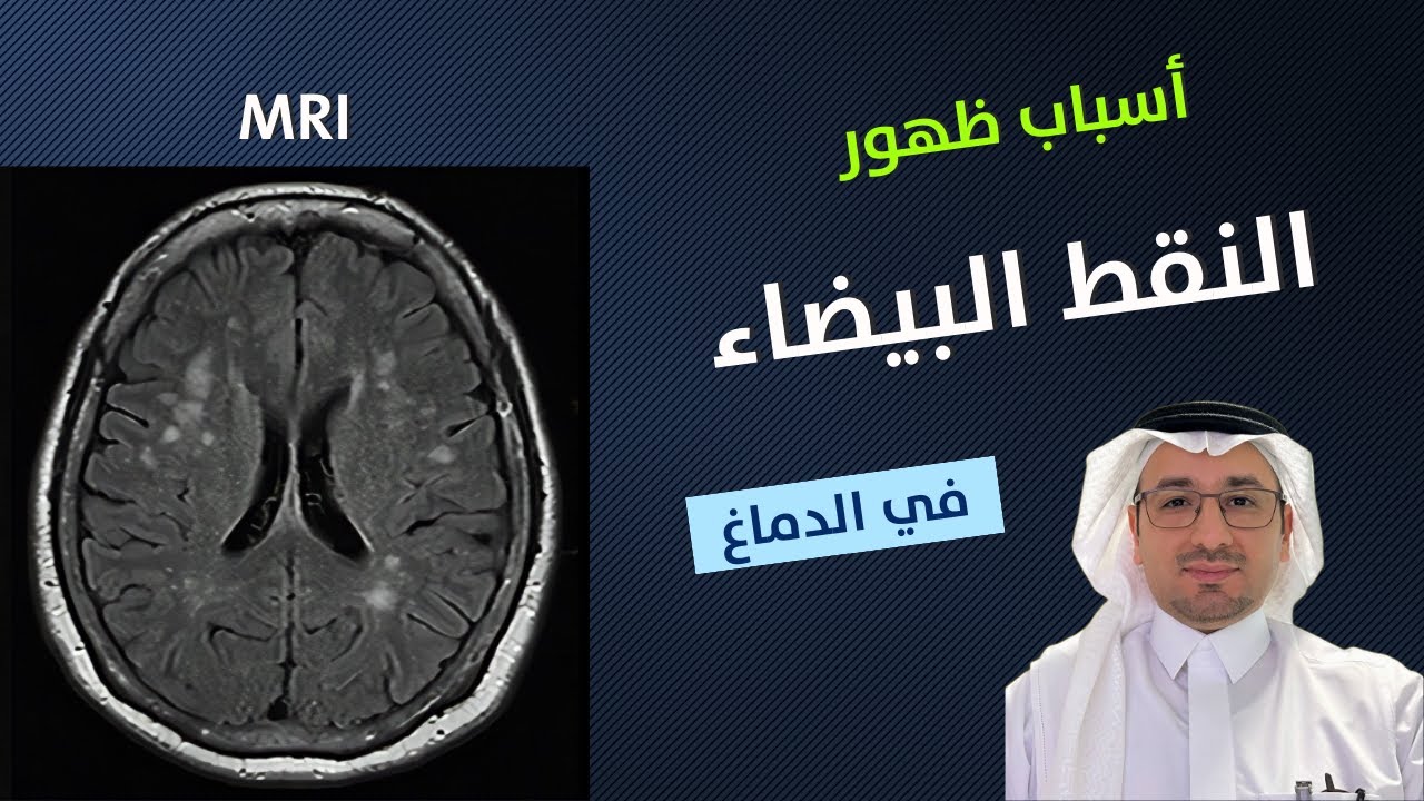 أسباب ظهور النقط البيضاء في الدماغ