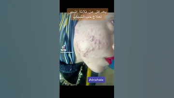 علاج حب الشباب فى خلال ٣ اشهر Drwaelmansour د وائل منصور 