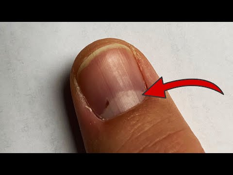 Video: Wusstest du etwas über Fingernägel?