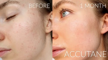 1 MONTH ACCUTANE JOURNEY PROGRESS FOR MILD ACNE | SIDE EFFECTS & SKINCARE