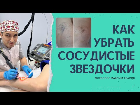 Как избавиться от сосудистых звездочек? Флеболог Москва.