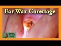 Ear wax suppression dune oreille pleine  medical group auburn