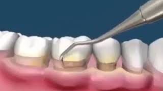 Teeth scaling and polishing