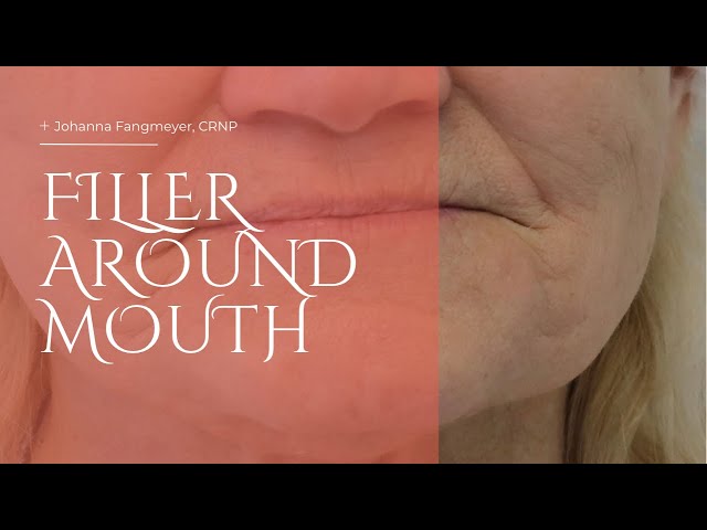 Filler Around Mouth