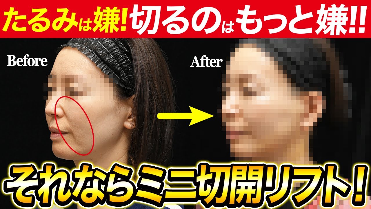 Before proceeding to a full facelift] An intraoperative