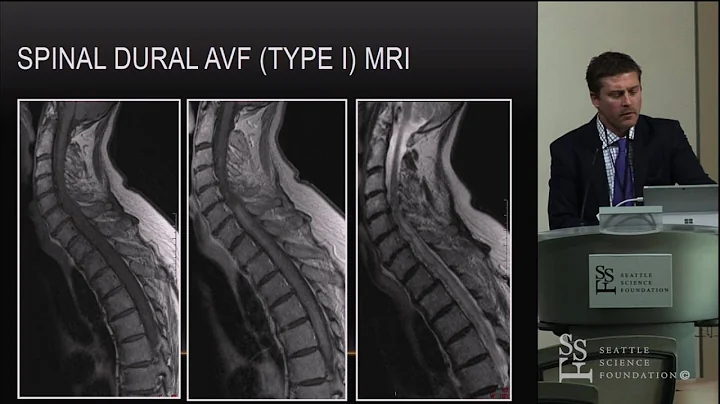 Spinal Vascular Malformations - Stephen Monteith, MD