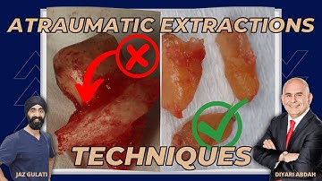 Atraumatic Extractions  - WHY and HOW? - PDP127