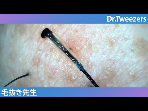 398 How is the transparent gel of the hair root made? 毛抜き先生の角栓や毛根