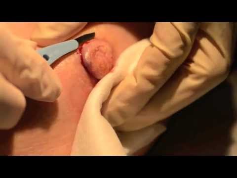 surgery excision #10