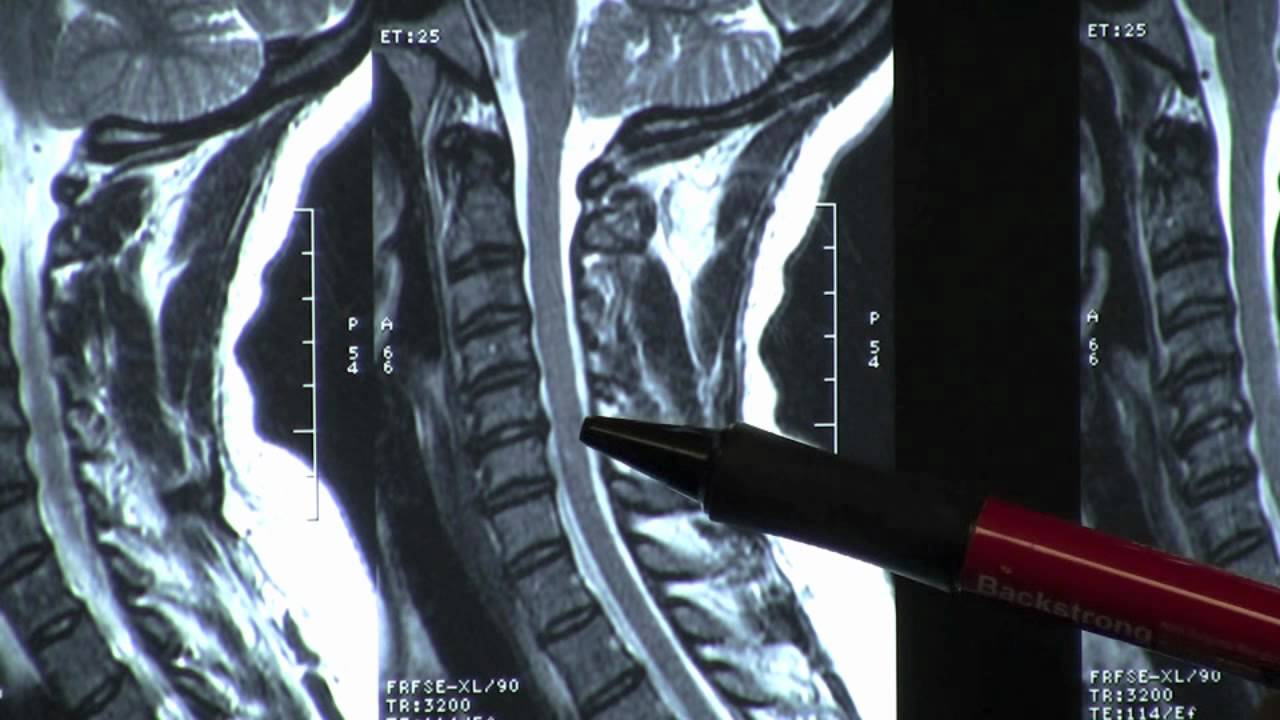 Atlanta Chiropractor And Physical Therapy Cervical Mri Explained Youtube