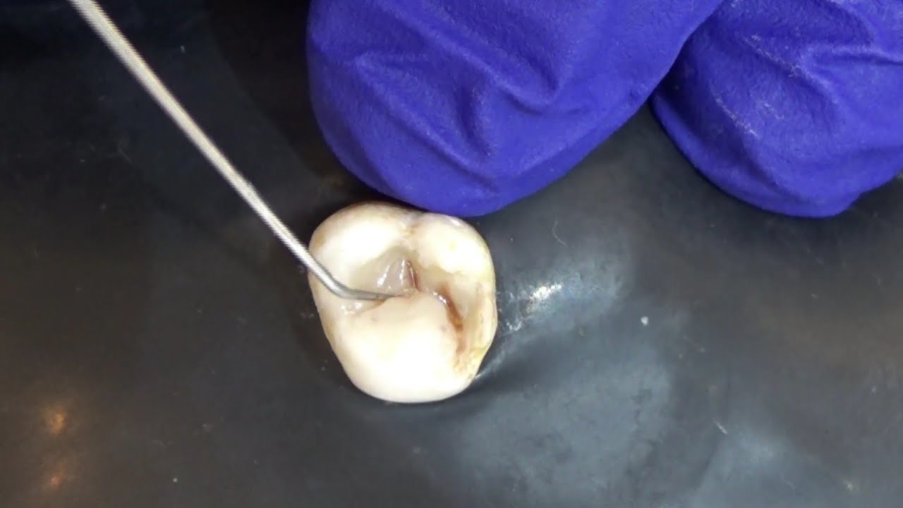 🔴PASSO A PASSO RESTAURAÇÃO POSTERIOR🥇 +BÔNUS ANATOMIA PRIMEIRO MOLAR ...